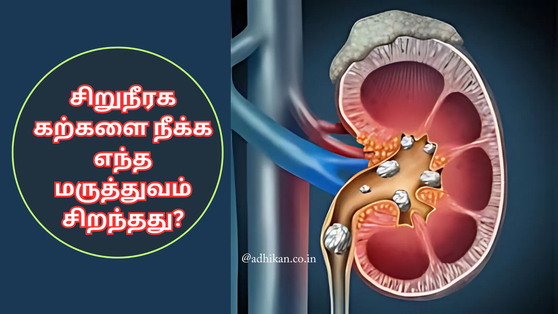சிறுநீரக கற்களை நீக்க எந்த மருத்துவம் சிறந்தது?