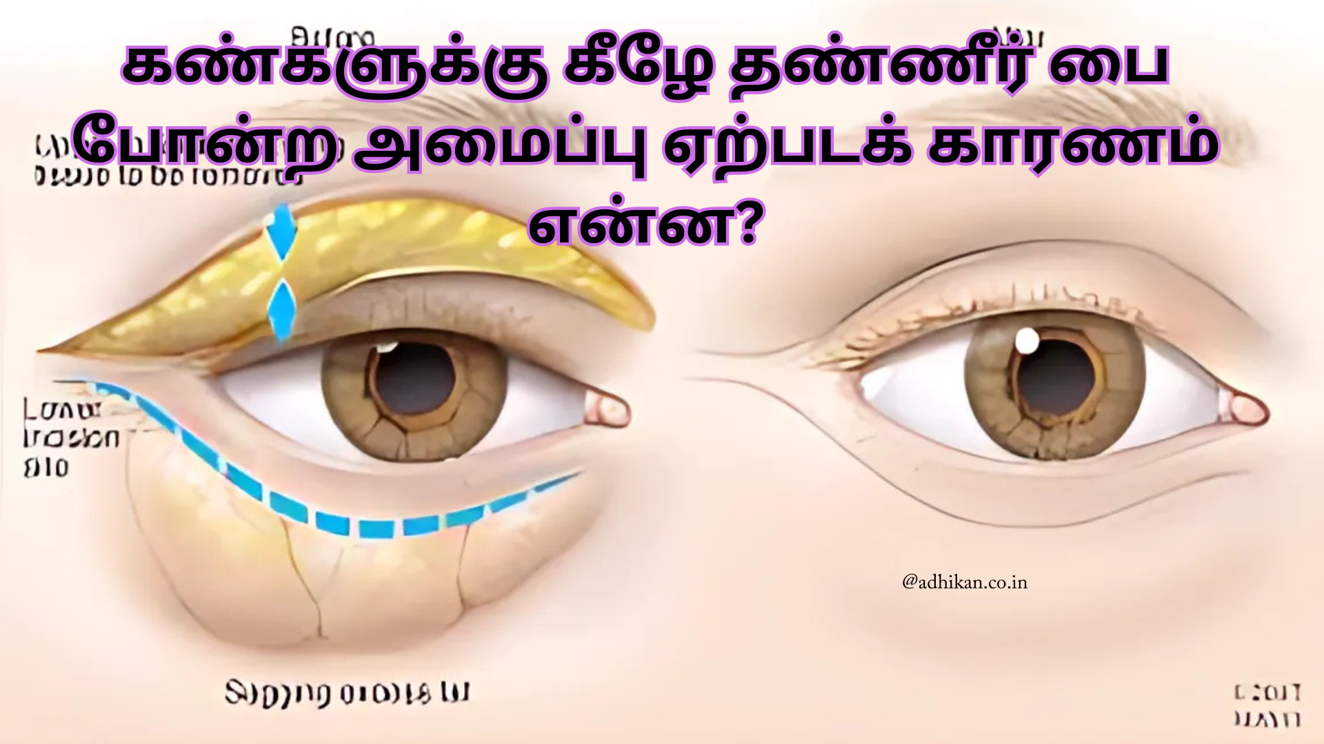 கண்களுக்கு கீழே தண்ணீர் பை போன்ற அமைப்பு ஏற்படக் காரணம் என்ன?